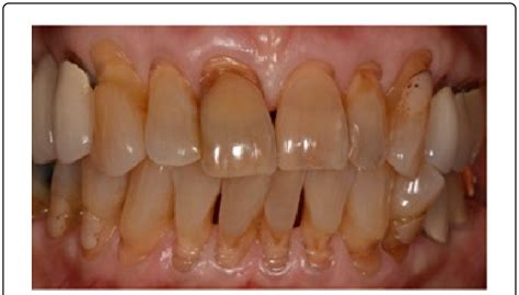 Generalized Abfraction Abfraction Lesions Of Different Shapes Widths