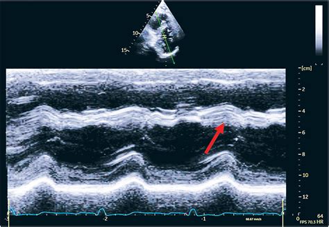 Echocardiographic Patterns Of Abnormal Septal Motion Beyond Myocardial