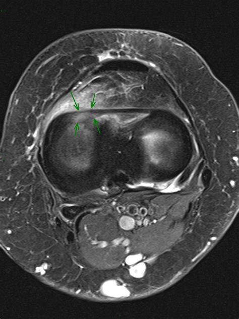 Transverse intermeniscal ligament rupture.