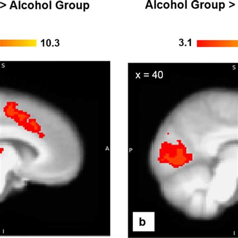 Group differences in anterior cingulate cortex activation. a Controls ...