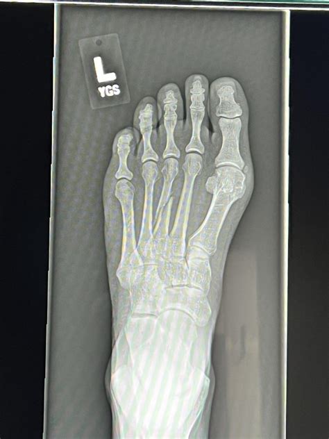 I Banged My Foot On A Corner 4 Weeks Later I Went To Get An X Ray Rwellthatsucks