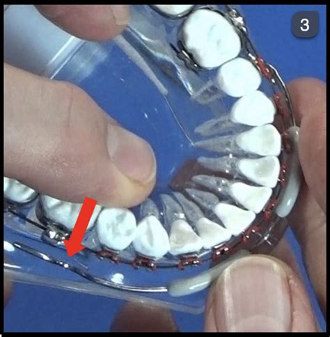 Orthodontic Demonstration Lip Bumper Video Williams Gp