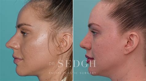 Crooked Nose Surgery Before After Photos Dr Sedgh