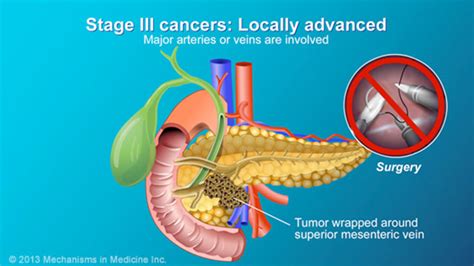 Pancreatic Cancer Pathophysiology Diagnosis And Staging