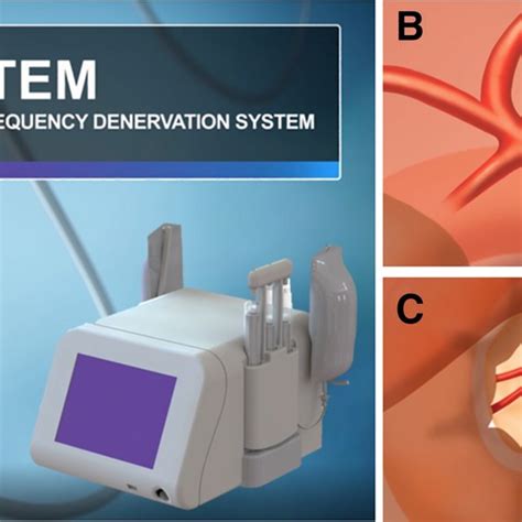 Integrated Radiofrequency Irf Denervation System A Multi Electrode Download Scientific