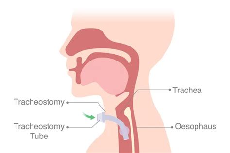 61 Tracheostomy Vector Images Depositphotos