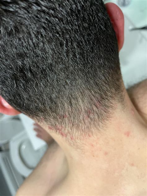 Hair Bumps On Back Of Neck