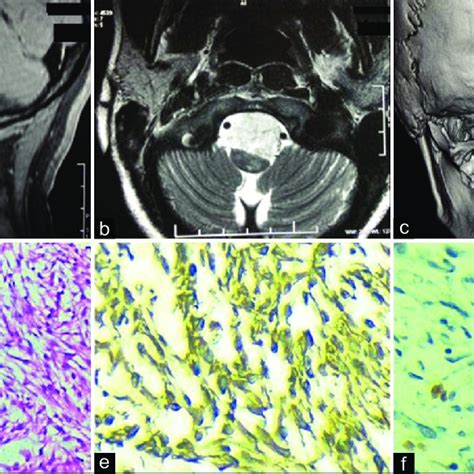 A Postoperative Sagittal Contrast Enhanced Magnetic Resonance Imaging