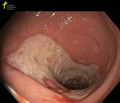 Ischämische Kolitis scharfe Abgrenzung