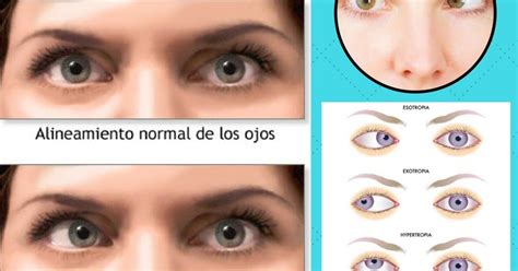 Cl Nica De Ojos Oftalmic L Ser Estrabismo