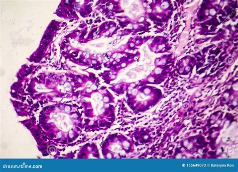 Villous Colon Adenocarcinoma Light Micrograph Stock Image Image Of