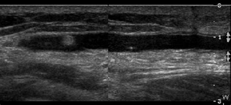 A 45 Year Old Man With A Postoperative Mass Palpated In The Area Of Download Scientific Diagram