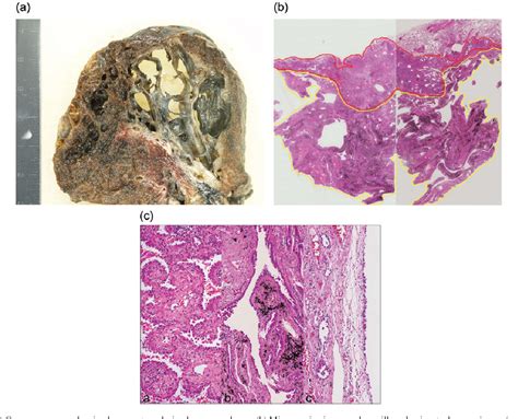 Figure 2 From Egfr Mutation Of Adenocarcinoma In Congenital Cystic Adenomatoid Malformation