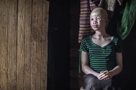 Albinos in Malawi are being abducted, murdered and mutilated for their ...