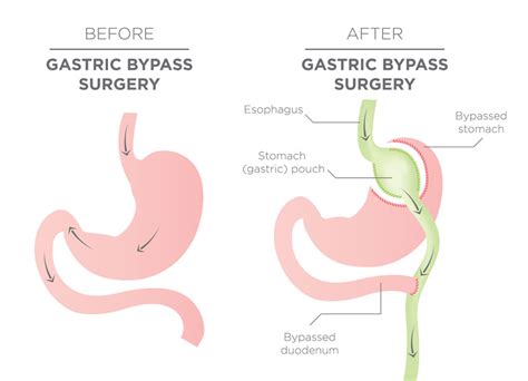 Gastric bypass diagram. | Obesity Coverage