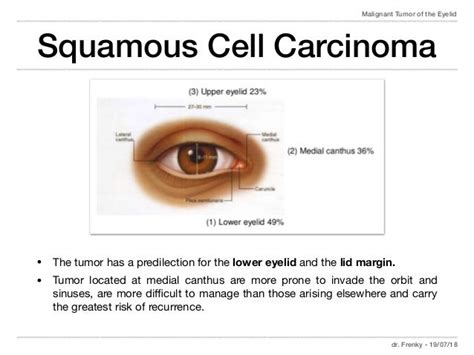 Malignant Tumor Of The Eyelid