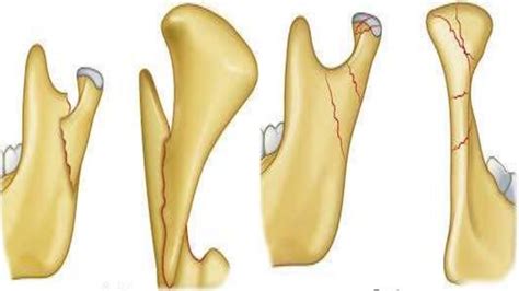 Condylar Fracture Ppt