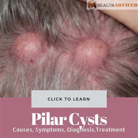 Pilar Cysts Causes Picture Symptoms And Treatment