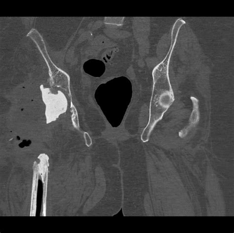 FEMORAL STEP SIX: CASE ONE - Proximal Femoral Replacement — Complex Hip ...