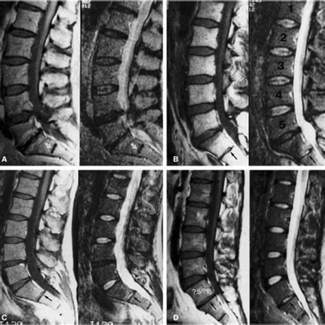 Castellvi Radiologic Classification Of Lumbosacral Transitional