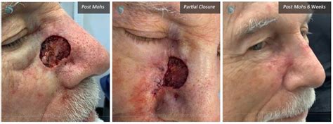 Mohs Skin Cancer Surgery New York Ny Laser Skin Surgery Nyc