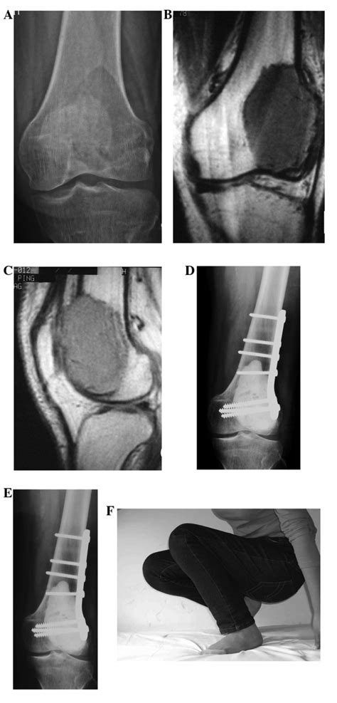 A 30 Year Old Female Patient With Giant Cell Tumor Gct Of The Left Download Scientific