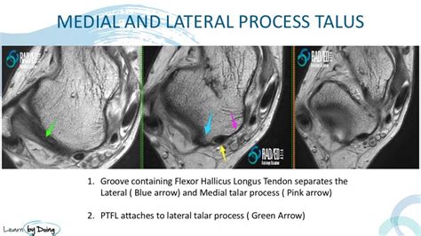 Posterior Ankle Impingement