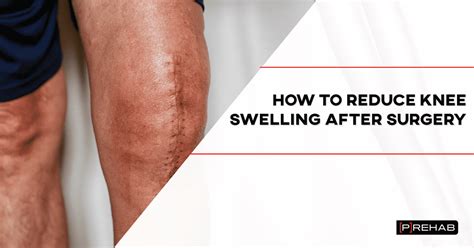 How To Reduce Knee Swelling After Surgery [p]rehab