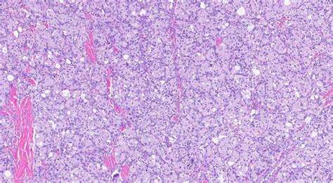 Paraganglioma | Atlas of Pathology