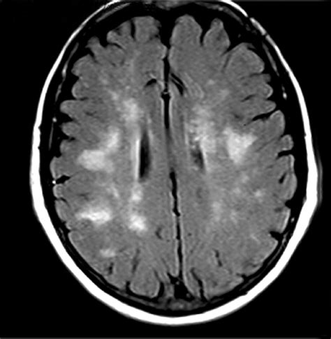 Central Nervous System Involvement In Andersonfabry Disease A