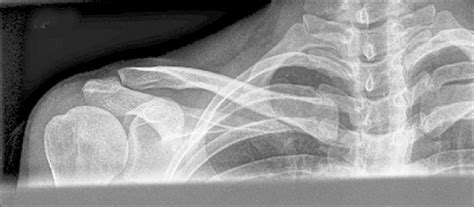 Anteroposterior AP View Of Clavicle X Ray Beam Directed