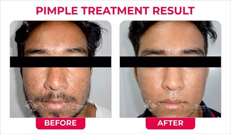 Acne Scars Removal Laser Treatment Sakhiya Skin Clinic