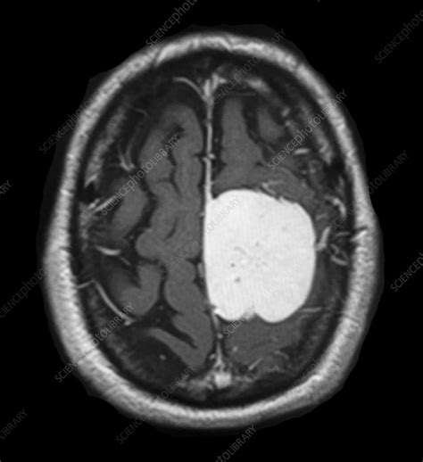 Parafalcine Meningioma Mri Stock Image C0430277 Science Photo