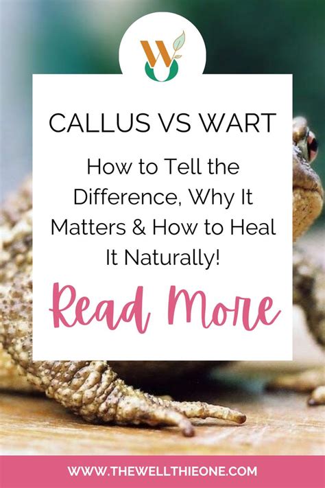 Callus Vs Wart How To Tell The Difference Why It Matters How To