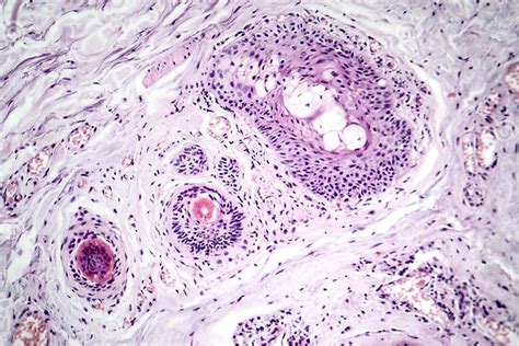 Basal Cell Carcinoma, Light Micrograph Stock Photo - Image of sample ... 