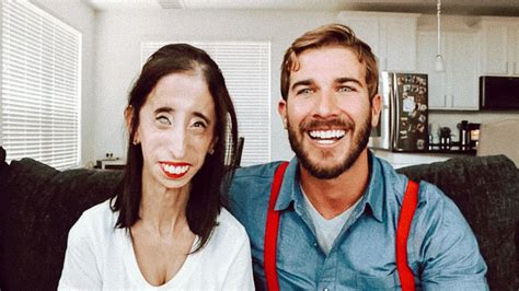 Meet Somebody with a Rare Genetic Condition - SBSK