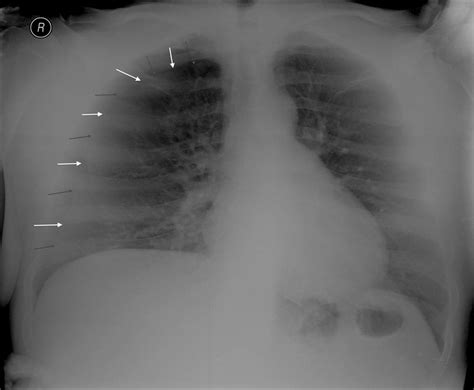 Anteroposterior Chest Radiograph After Onset Of Respiratory Symptoms A