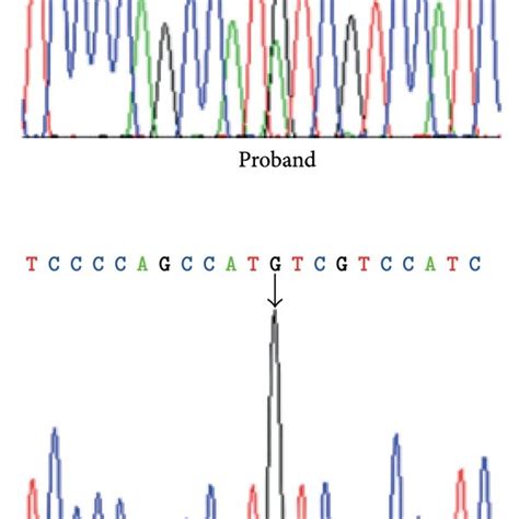 Sanger Sequencing Chromatogram Revealing The Pathogenic SMAD3 Mutation