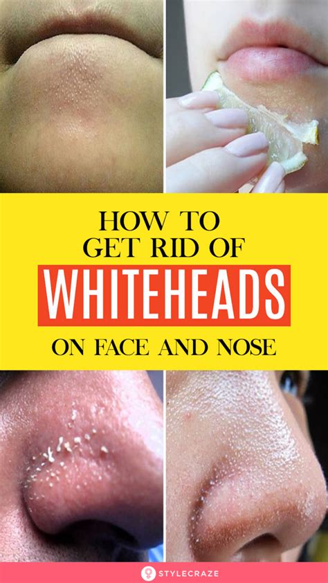 Whiteheads – Artofit