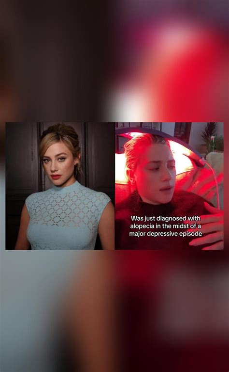 Watch Riverdale Actor Lili Reinhart Reveals Alopecia Diagnosis Entertainment News Inshorts