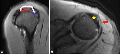 Supraspinatus Tear Mri