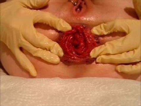 Asshole Prolapse Prolapse Ass Pierced Mature Stretched Her Huge Asshole Prolapse