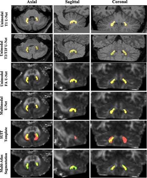 Dentate Nucleus Mri