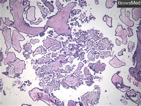 Serous Papillary Borderline Tumor