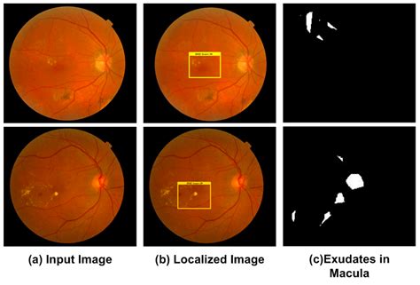 Applied Sciences Free Full Text Retinal Image Analysis For Diabetes