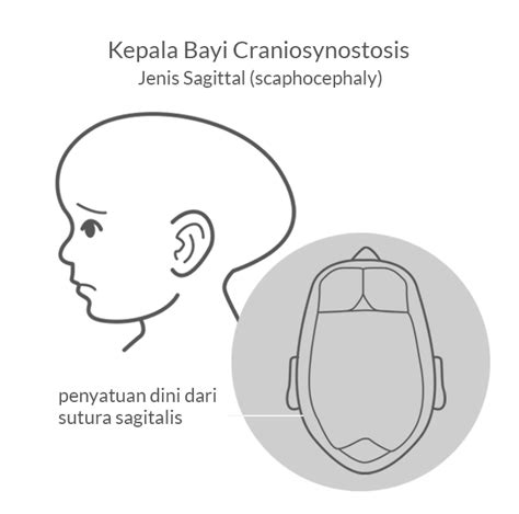 Apa Itu Craniosynostosis Orthopaedia Indonesia