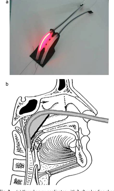 Figure From Surgical Debulking Combined With Photodynamic Therapy To