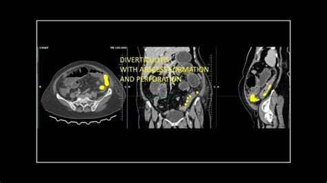 Sigmoid Colon Diverticuli Tis With Focal Perforation Of Diverticulum With Abscess Formation