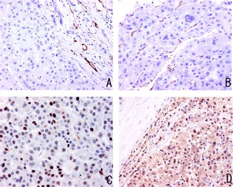 Cd Expression In Hcc And Non Hcc Liver Tissue A Cd Red Was