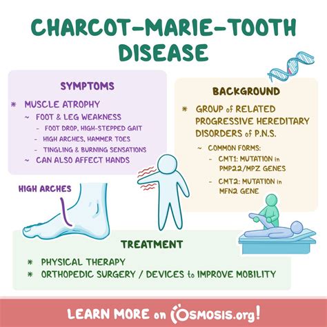 Charcot Marie Tooth Foot